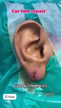 Ear lobe repair is a minor surgical procedure designed to fix torn, stretched, or damaged ear lo