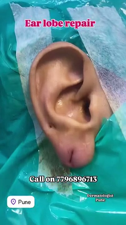 Ear lobe repair is a minor surgical procedure designed to fix torn, stretched, or damaged ear lo