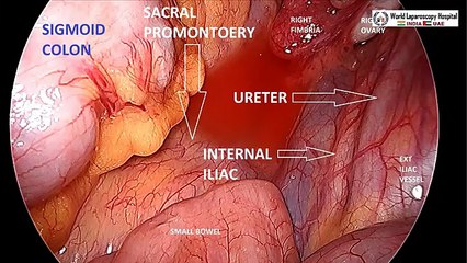 Diagnostic Laparoscopy, Hysteroscopy and Dye Test for Infertility