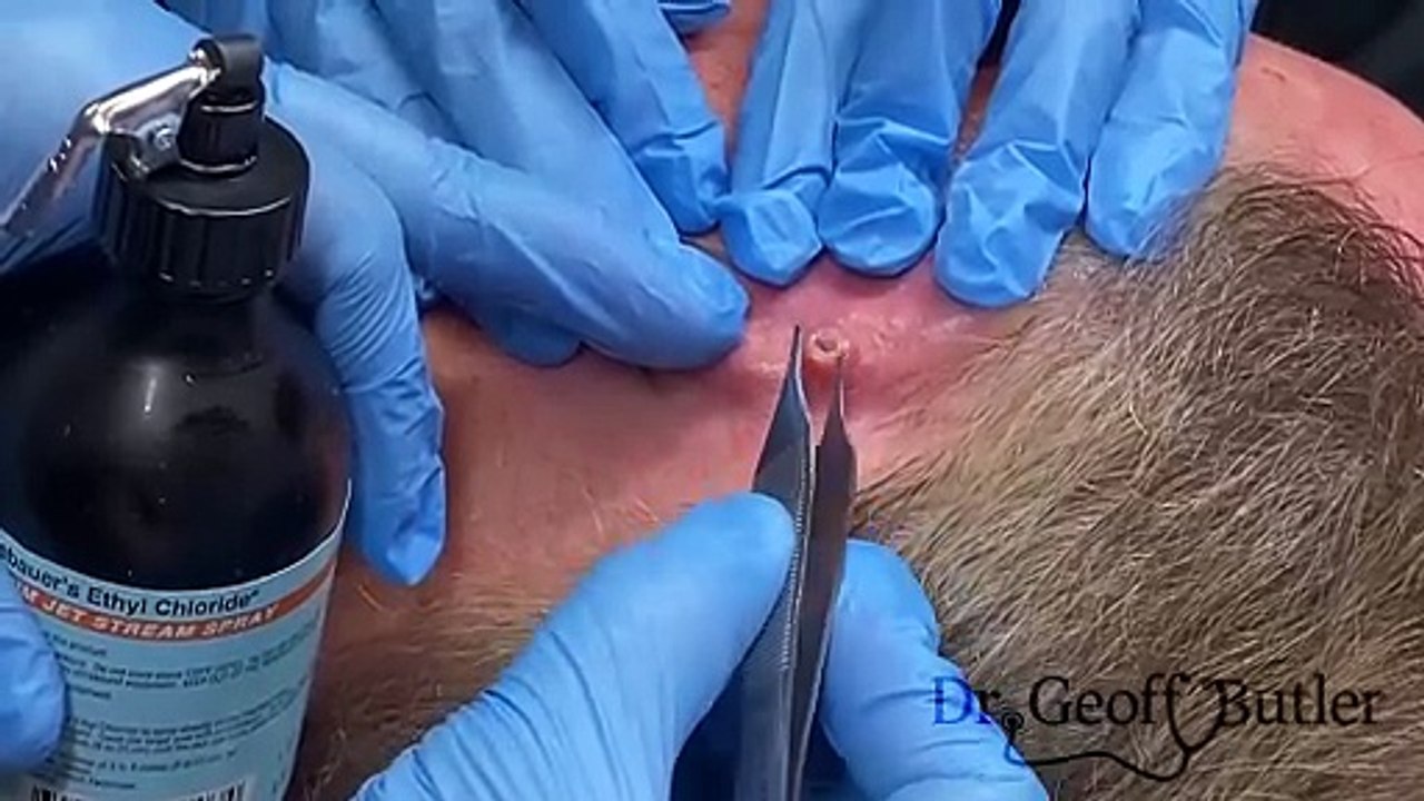 Removal of a Squamous Cell Cancer from behind the Ear