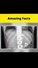 Craziest Things EVER Found in Human Body!  #shorts  #FactBeast90 - Fact Beast90