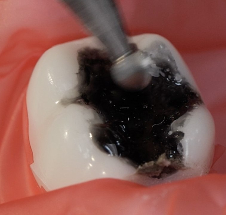 Smile more with a dental cleaning process 🦷 #dentist #gadgets #teethcleaning#howto #smile #teeth