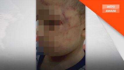 Kanak-kanak 2 tahun cedera disyaki didera pengasuh