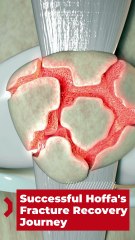 Successful Hoffa’s Fracture Recovery Journey | Patient Success Story with Dr. Prof Amit Kumar Agarwal