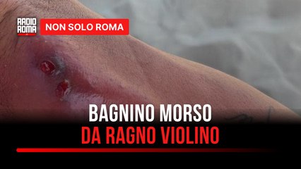Bagnino morso dal ragno violino a Torvaianica: "Ho rischiato la setticemia"