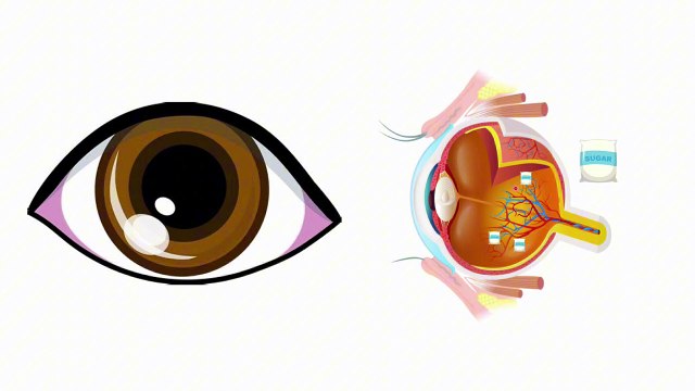 ¿Por qué la diabetes mal controlada daña la vista? #elcuerpoymas #medicina #salud #diabetes