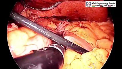 Full-Length Skin-to-Skin Mini Gastric Bypass Surgery Video From World Laparoscopy Hospital