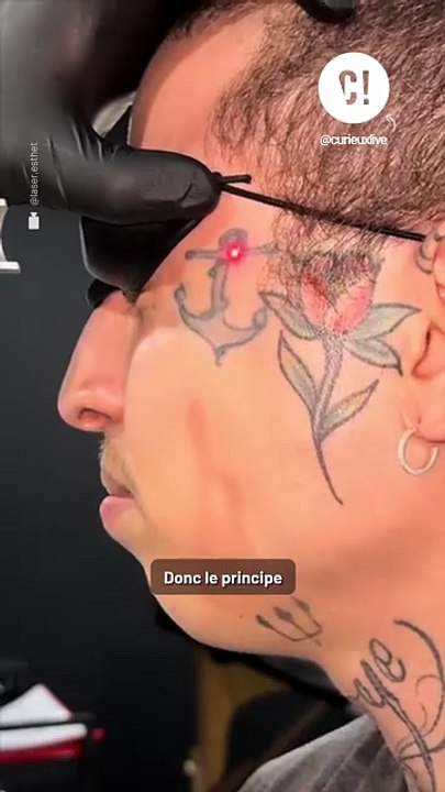 Comment marche le détatouage laser ?