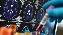Alzheimer, la gravità della malattia sarà valutabile con un semplice esame del sangue
