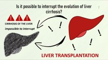 Is it possible to interrupt the evolution of liver cirrhosis?