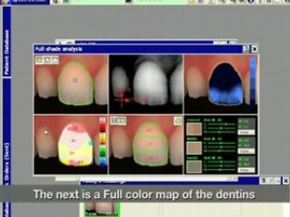SPECTROSHADE MHT Fast Color Analysis
