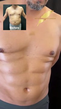 👉 Get ready to sculpt your dream body with VASER Liposuction and Renuvion Skin Tightening.