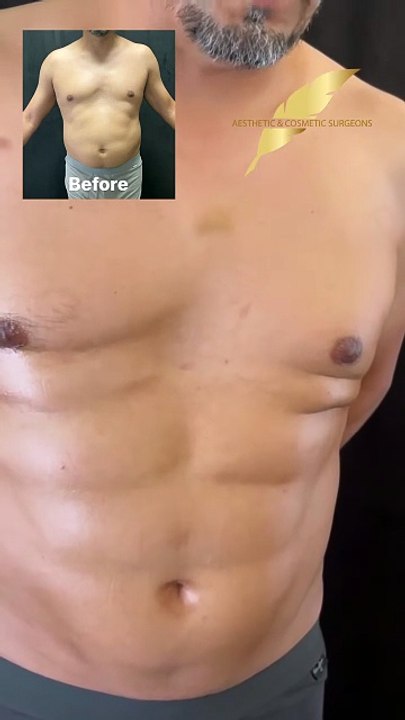 👉 Get ready to sculpt your dream body with VASER Liposuction and Renuvion Skin Tightening.