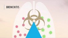 Treatment of bronchitis