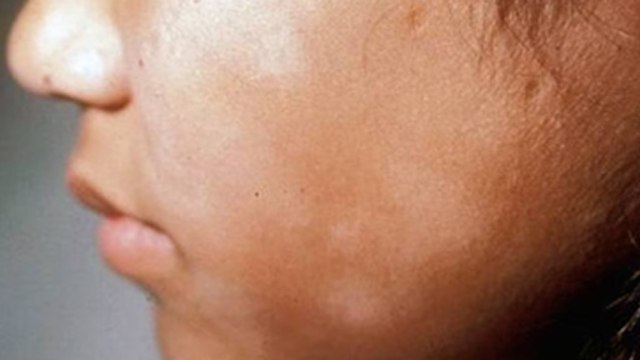 White Spot On Kids Face: बच्चे के चेहरे पर सफेद धब्बे क्यों होते है,दाग कैसे हटाएं | Home Treatment