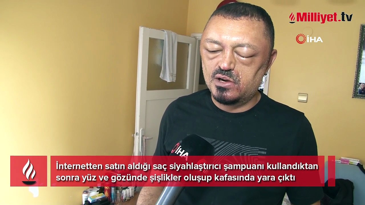 Berber tavsiyesiyle internetten saç siyahlaştırıcı şampuan aldı, yüzü ve gözü şişti