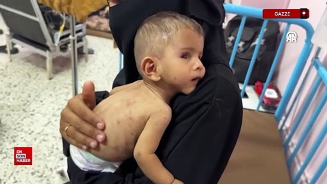 İsrail'in açlığa mahkum ettiği Gazze'de Filistinli bebek yaşam mücadelesi veriyor