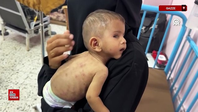 İsrail'in açlığa mahkum ettiği Gazze'de Filistinli bebek yaşam mücadelesi veriyor