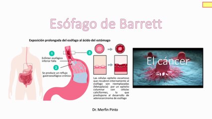 Esófago de Barrett #elcuerpoymas #medicina #salud #sangradodigestivo