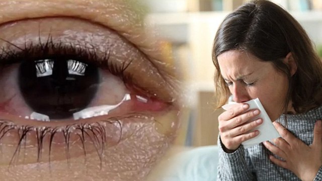 Fever Cough Watery Eyes Treatment: सर्दी,खांसी,बुखार,आंखों से पानी आने पर क्या करें,कारण और इलाज