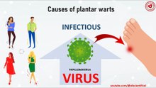 Causes of plantar warts: papillomavirus