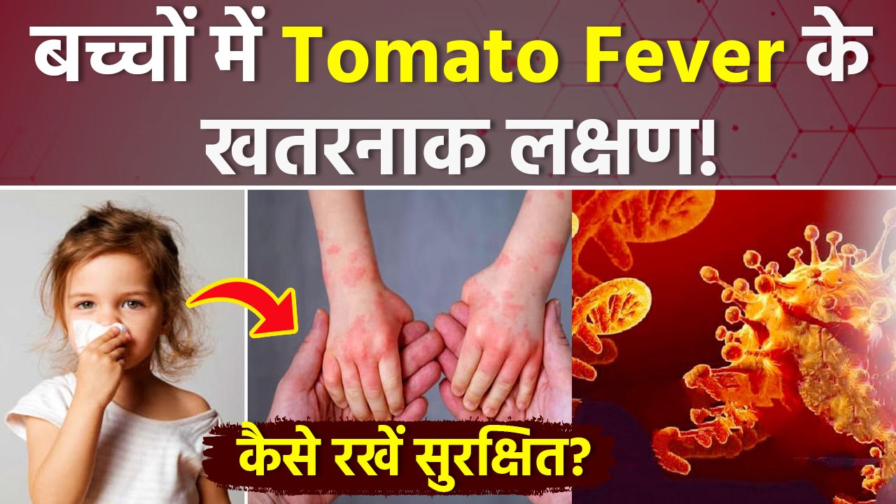 Tomato Flu Causes: टोमैटो फ्लू क्या है, Symptoms & Home Remedies ...