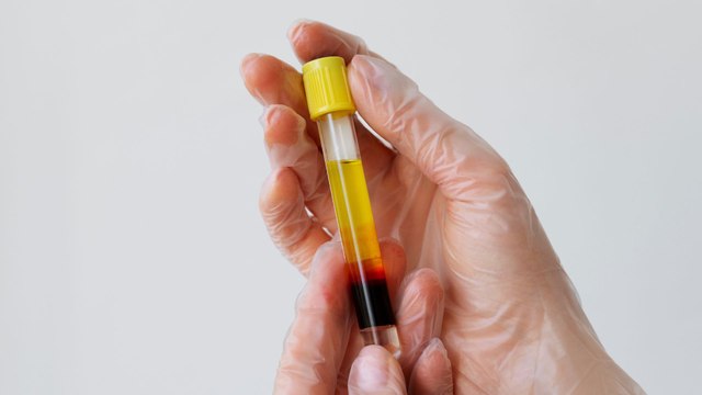 Transfusiones de plasma: la técnica con la que se podrían tratar enfermedades sin cura