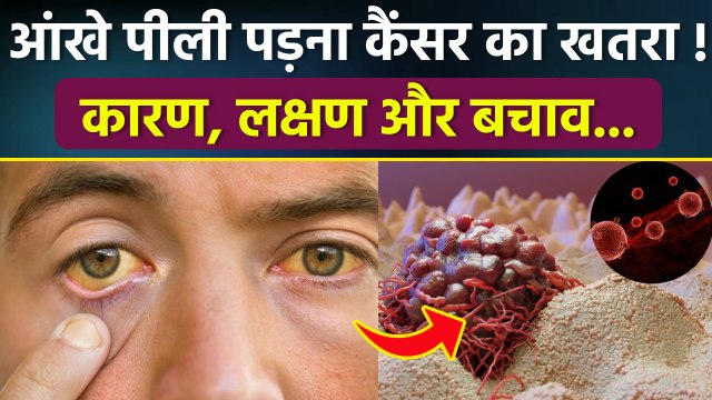 Leukmia Causes: आंखों का पीला रंग सिर्फ पीलिया नहीं, हो सकता है Blood Cancer, Symptoms & Treatment..