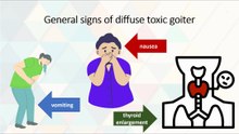 General signs of diffuse toxic goiter