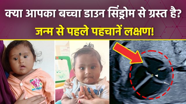 Down Syndrome In Babies:डाउन सिंड्रोम क्या है, कैसे कम कर सकते हैं | Symptoms & Causes | Boldsky