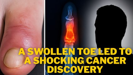 A Swollen Toe Revealed His Final Diagnosis