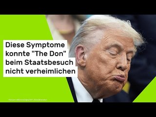 Krankenakte Donald Trump: Diese Symptome konnte "The Don" beim Staatsbesuch nicht verheimlichen