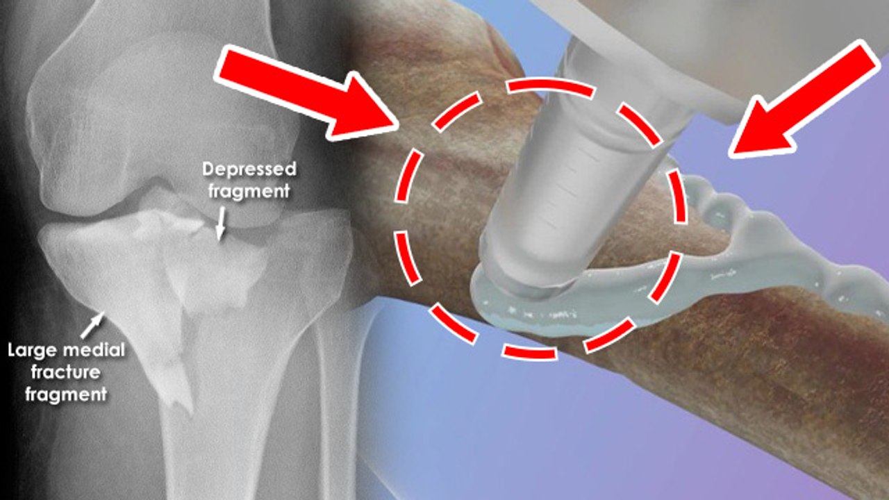 China Bone Glue Fracture Treatment: 3 Minute में टूटी हड्डी का इलाज,  Process & Cost Details...