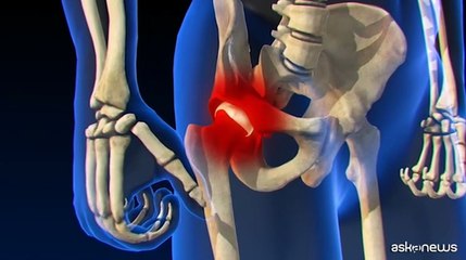 Protesi anca e ginocchio: numeri record