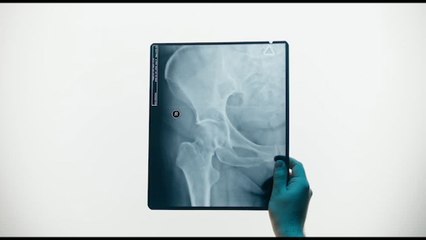 Protesi anca e ginocchio: numeri record