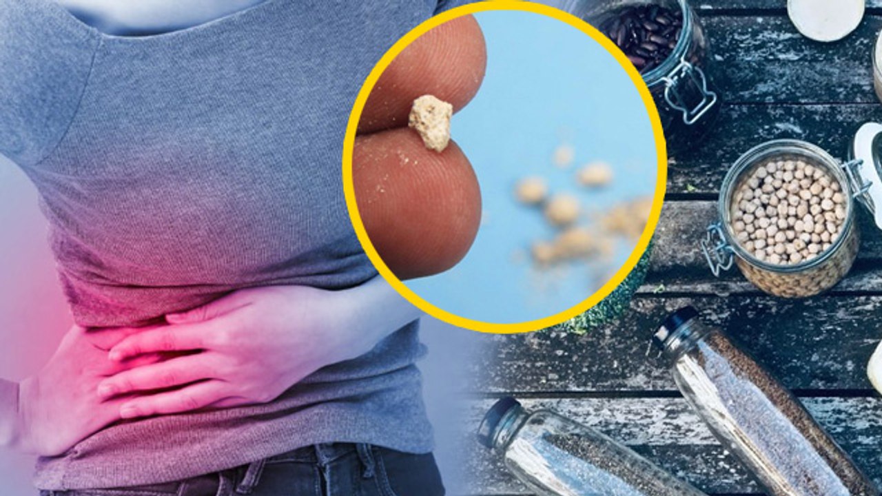 Kidney Stone Causes:किडनी स्टोन में क्या खाना चाहिए और क्या नहीं | Benefits In Hindi | Boldsky