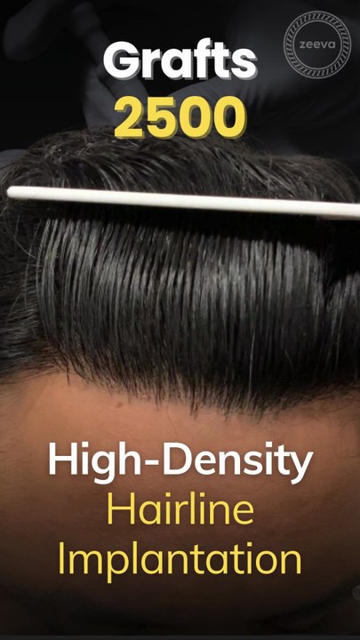 11 Months Hair Transplant Results | Hair Transplant In Ahmedabad, India