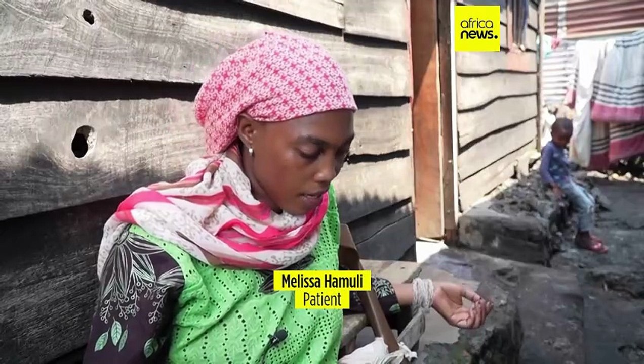 Amid escalating violence in Eastern Congo, demand for prosthetics soars