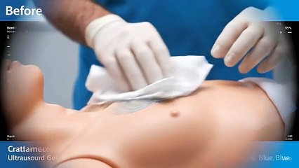 Enhance your ultrasound experience with Chattanooga® Conductor Ultrasound Gel, Blue! 💙