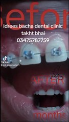 Braces #dentis#world#short#love