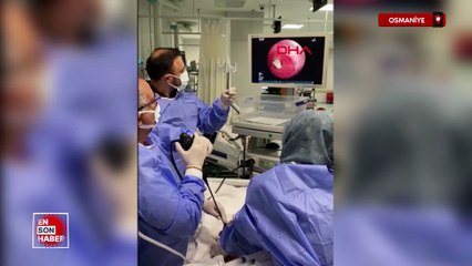 Osmaniye'de hastanın akciğerine kaçan sarımsak operasyonla çıkarıldı