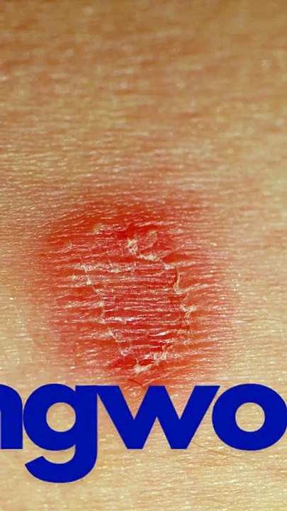 Skin conditions