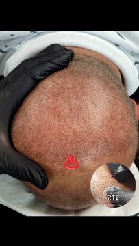 Saç Simülasyonu By Haluk Şener Saç Çözümleri Pigment İşleme SMP Telefon Aşağıda