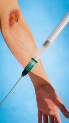 Blown Veins 😟 (explained)