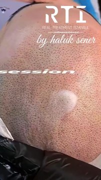 Saç Simülasyonu Gölgeleme Doğal Pigment ve Uzmanlık İçin Doğru Adres By Haluk Şener Telefon Aşağıda