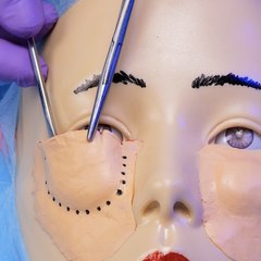 Bye-Bye les poches sous les yeux ! La magie de la blépharoplastie inférieure ✨