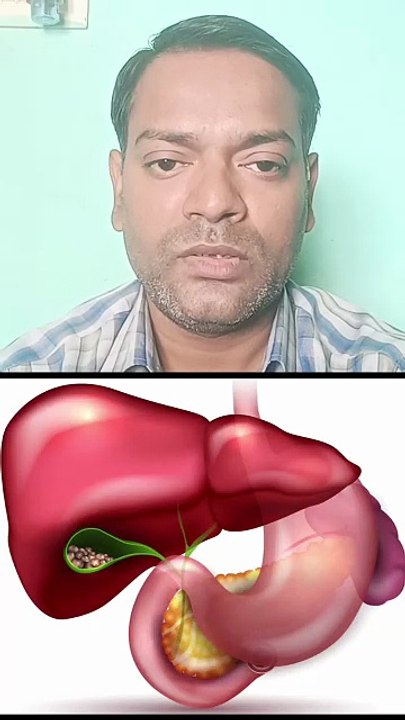 पित्ताशय की पथरी ।