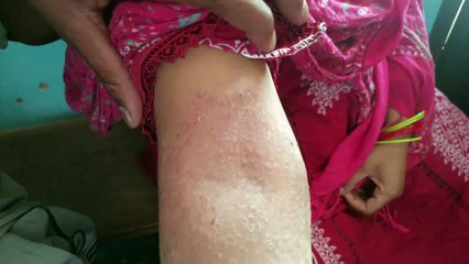 4 सालों से शरीर पर लाल दाद थें अब सही इलाज होने से फायदा मिला ।