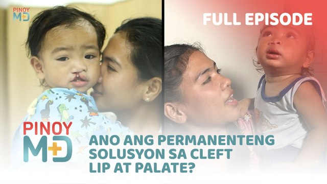 Ano ang permanenteng solusyon sa cleft lip at palate? (Full Episode) | Pinoy MD