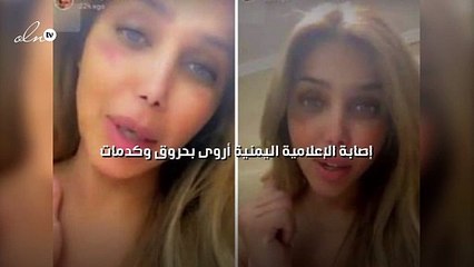 إصابة الإعلامية اليمنية أروى بحروق وكدمات